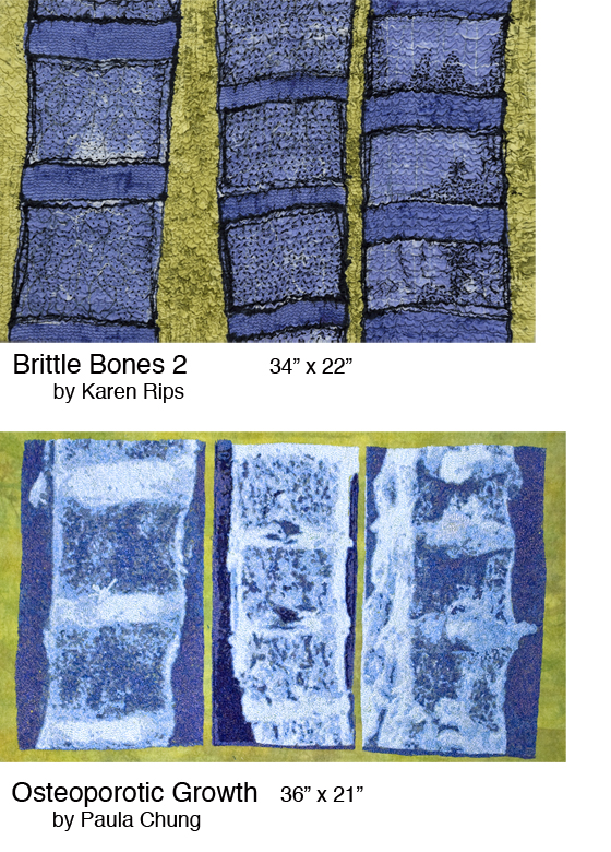 Brittle Bones 2/Osteoporotic Growth