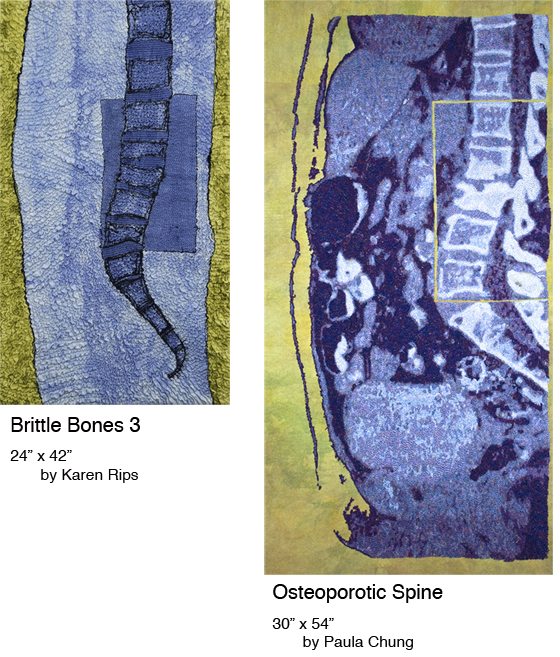 Brittle Bones 2/Osteoporitic Growth