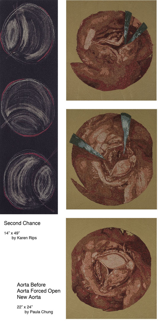 Second Chance - Aorta Before New Aorta