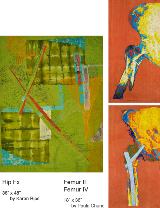 Hip Fx/Femur II & IV